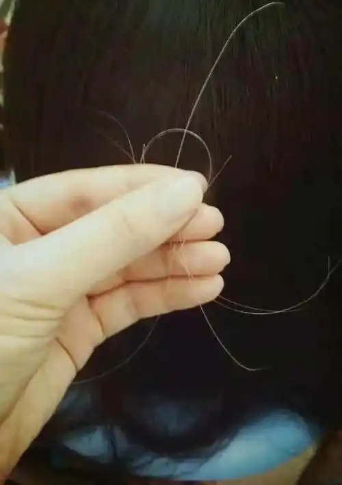 为什么头上白头发越来越多是不是身体里缺什么