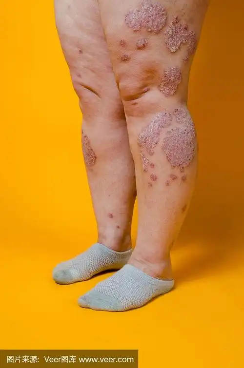 皮肤皮肤疾病.牛皮癣,湿疹,皮炎,过敏.肘部皮肤损伤.