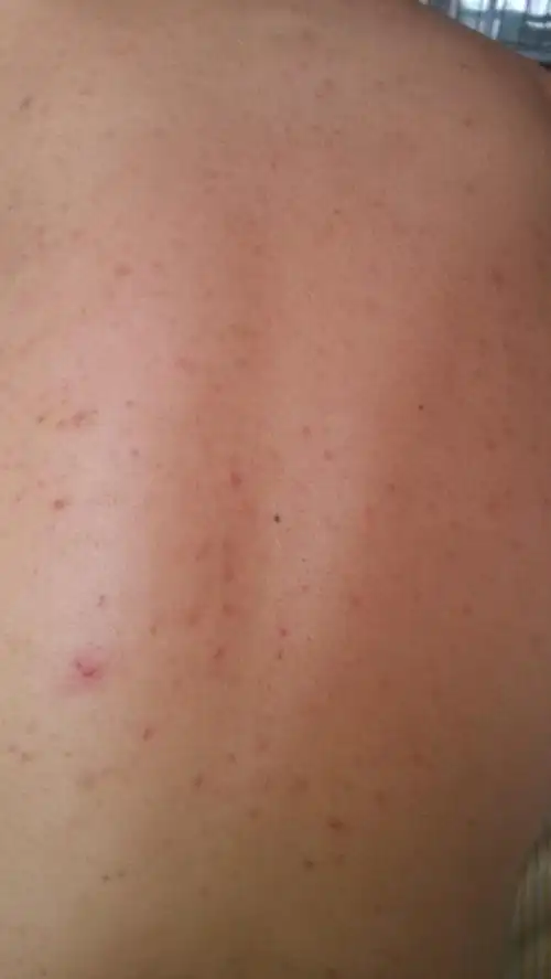 现在有点严重 平时也比较痒 也去过医院 有的说是毛囊炎有的