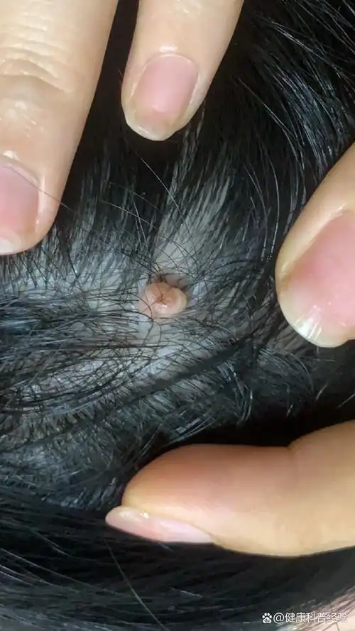 头上长了颗肉球