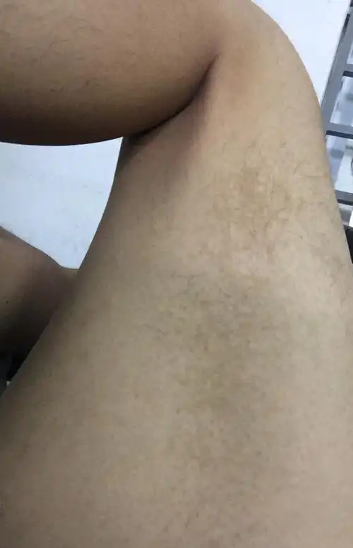 大腿外侧突然发现类似老年斑这样的斑,请问是怎么回事?