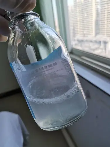 pap(肺泡蛋白沉积综合征)一例