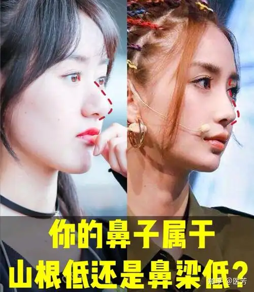山根低,鼻梁低的特点:常见于南方,一般塌鼻子都伴随着这两个特点,如果