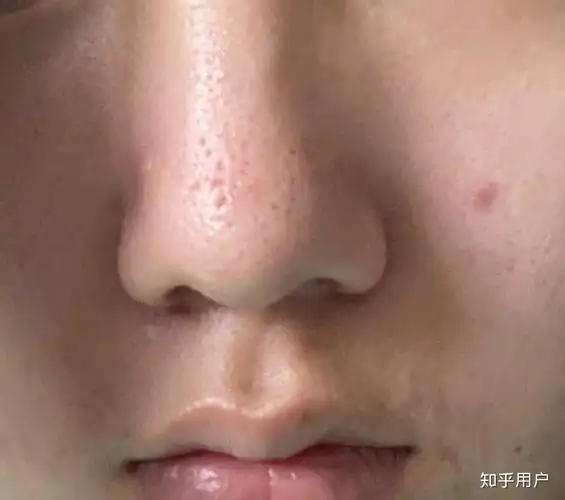 挤黑头鼻子有凹坑怎么办啊