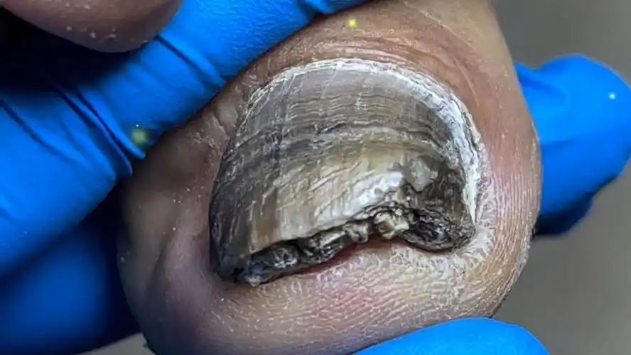 超脏的灰指甲,满是细菌