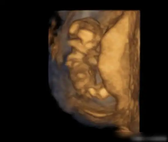 关于nt检查,孕妈妈孕13周前一定要看|羊水|胎儿|b超|穿刺|孕妇_网易