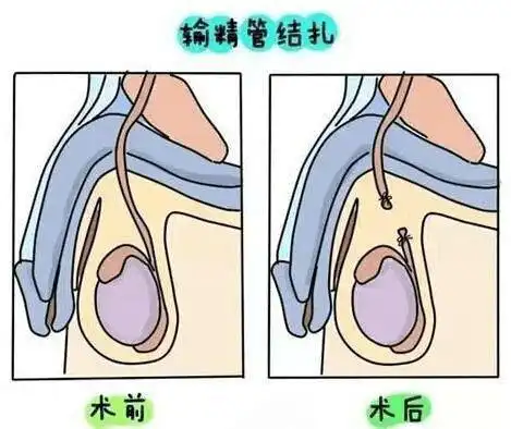女人不愿意结扎,上环,其中缘由看完你才会明白