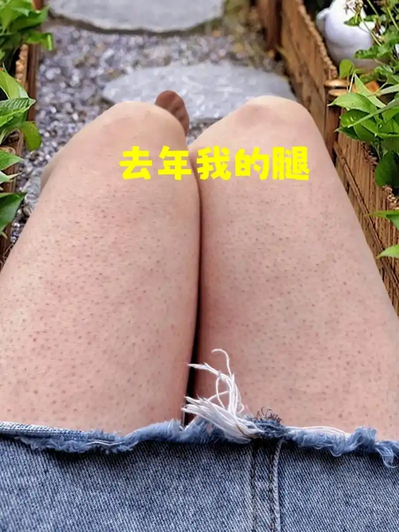 鸡皮肤 多亏了舞蹈生闺蜜告诉我的#尿素霜去鸡皮 小妙招!没 - 抖音