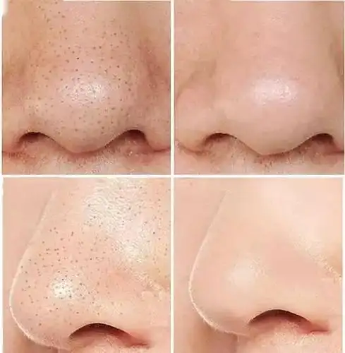 脸部皮肤毛孔怎么变小毛孔凹陷能自愈吗