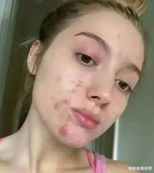 从完美皮肤到满脸爆痘这个女孩的经历让人想给她掌声