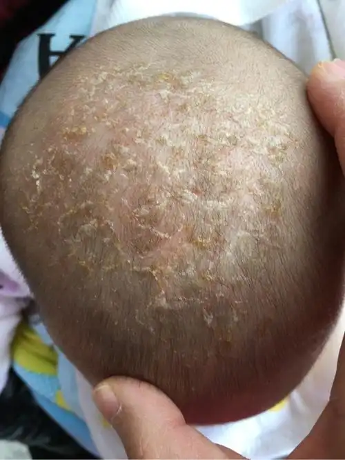 宝宝头顶结痂