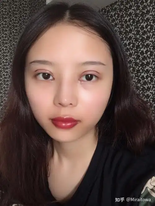 成都双眼皮全切无痕款!术后两个月分享 - 知乎