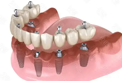 种植牙采集后的价格已更新 - 贝色口腔