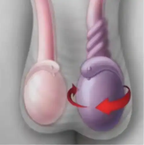 厦门10岁男孩半夜突然"蛋疼",一查竟是睾丸扭转720度!