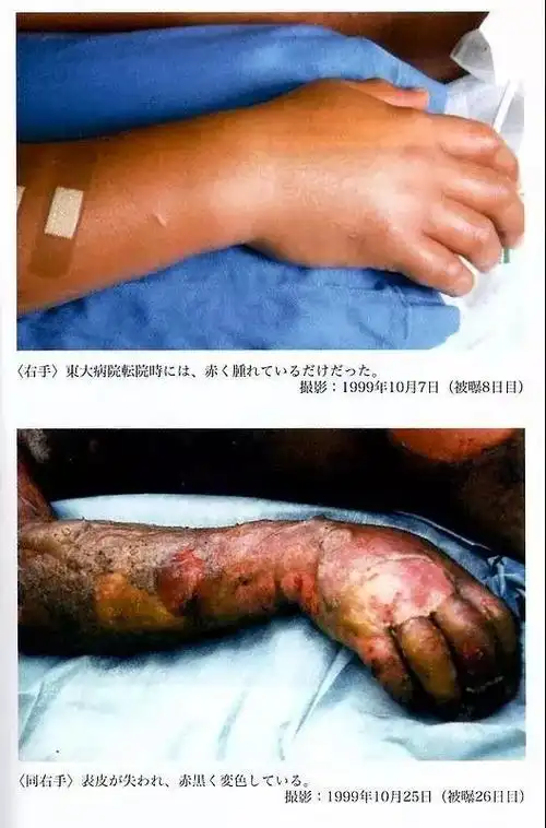 83天活体腐烂,他在核事故后缓慢死去,现代医学除了延缓死亡束手无策