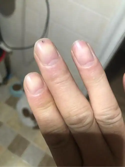 结疗9个多月,今天早晨发现平时正常的指甲变紫-淋巴瘤之家