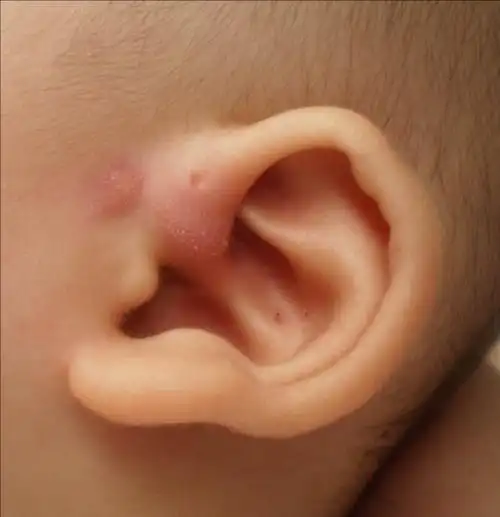宝宝耳朵发炎怎么办 6 2006-06-11 耳道发炎 7 2010-02-25 耳道发肿