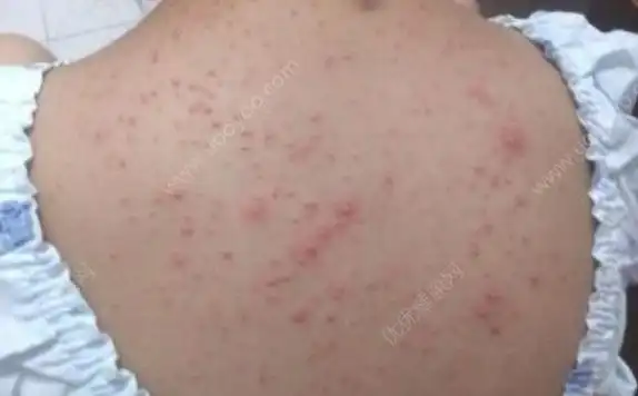 毛囊炎最佳治疗方法是什么毛囊炎怎么根治图