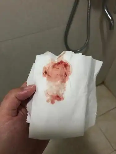 比如宫颈糜烂,宫颈癌等妇科炎症,在行房事之后是会有少量出血的