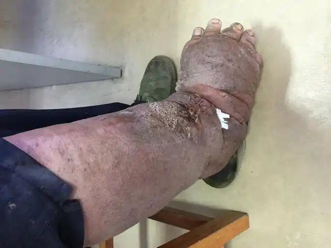 门诊惊现"象足腿":需要截肢吗? [病例帖]