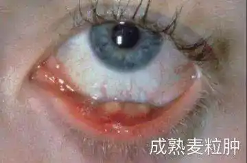 ②成熟麦粒肿 内麦粒肿切排