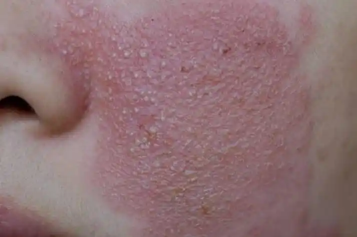 紫草油过敏面部皮炎图