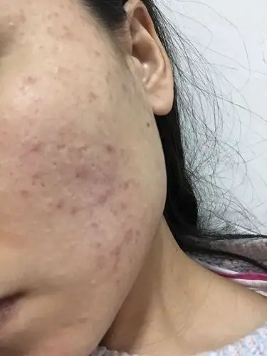 问:是用化妆品过敏吗 2个月前 脸颊两处起了密密麻麻的像米粒的痘痘