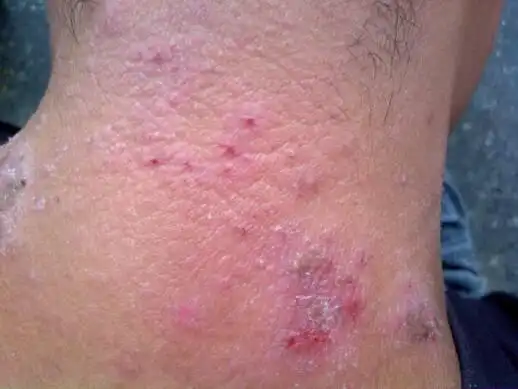 前期不痛不痒目前有针扎 灼热样痛