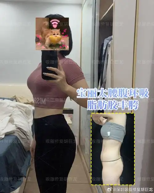 腰腹环吸##脂肪丰胯