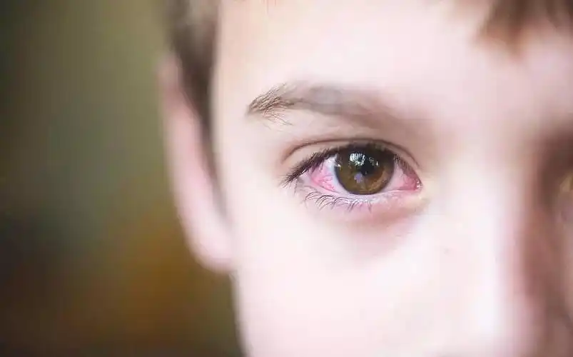 眼睛布满红血丝只是没睡好?