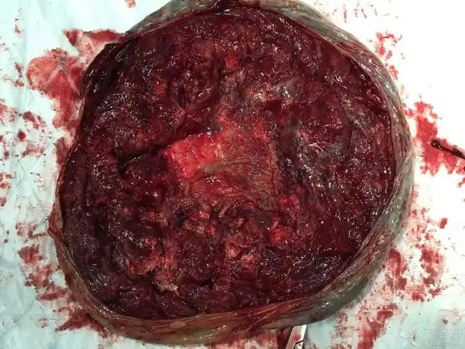 见过这样的胎盘吗