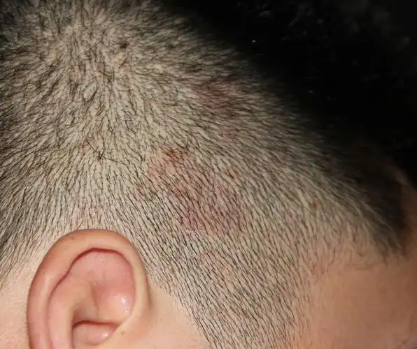 头皮上长红斑,头皮屑多