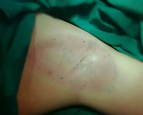 经典改良小切口腋臭手术术后