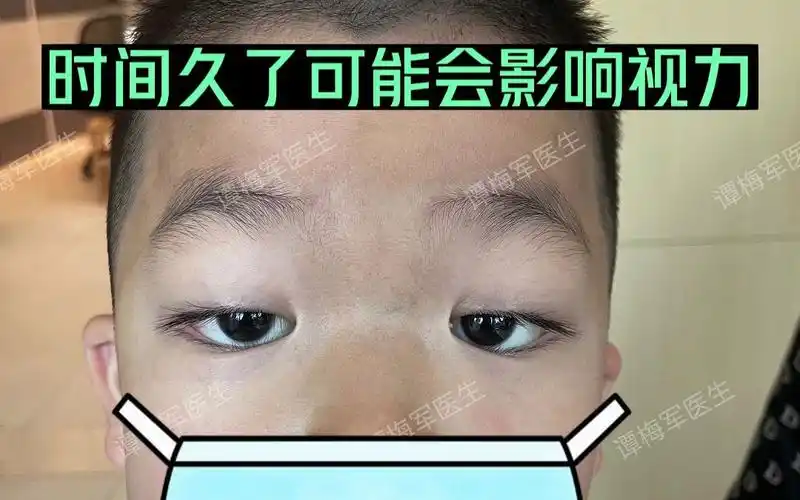 5岁小男孩重度上睑下垂伴肌无力,眼睛只能半睁