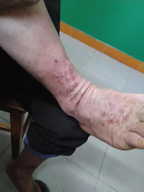 双下肢湿疹20年(治疗前照片) - 好大夫在线