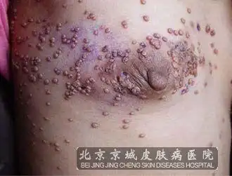 艾滋病的临床表现有哪些?