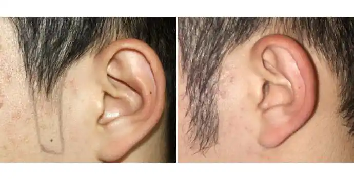 种植鬓角前后对比图种植鬓角效果图种植鬓角前后对比照片