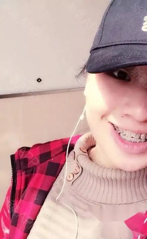 虎牙牙齿矫正,来张三个月的对比图呗