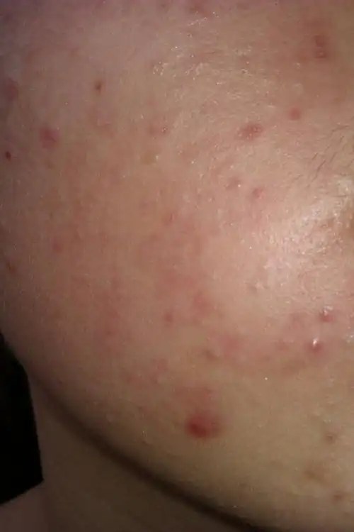 脸上长了一片小痘痘(好多天了),早上起来洗完脸之后就变得敏感发红.