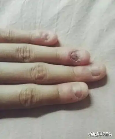 孩子总咬指甲真正的原因在这里