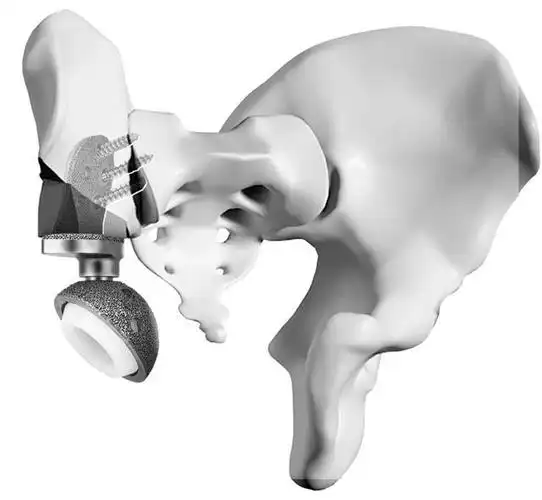 让骨肿瘤患者有尊严地站立——中国"3d打印钛合金组配式人工半骨盆