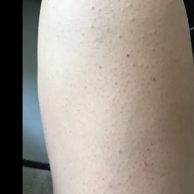 %的妈妈正在使用 残忍拒绝 推荐回答              这个属於毛囊堵塞