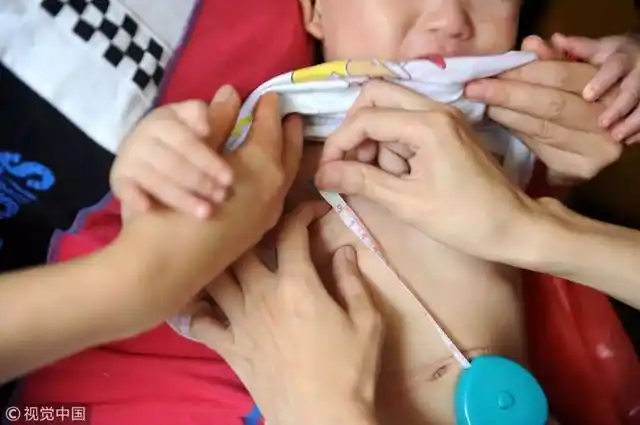 福建泉州市儿童医院,14个月大的琪琪胸部已经明显发育 | 视觉中国3