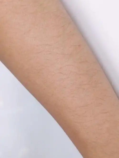 终于受不了我浓密的体毛,去激光脱毛了