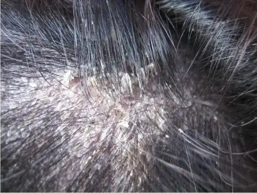 头上结痂长皮炎
