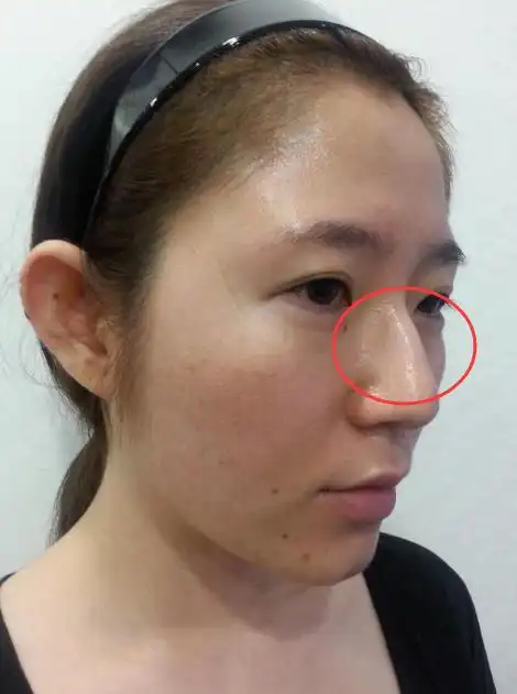 驼峰鼻整形费用多少果好不好