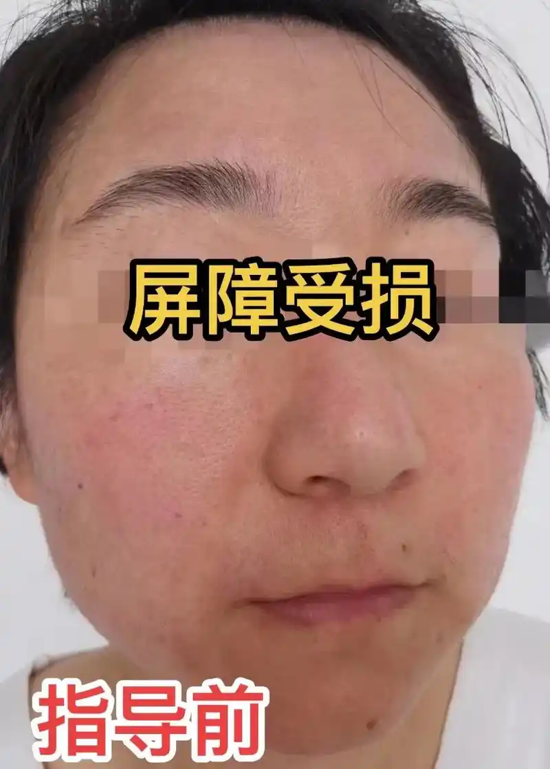 屏障受损有很多种,你知道自己是哪种受损问题吗?