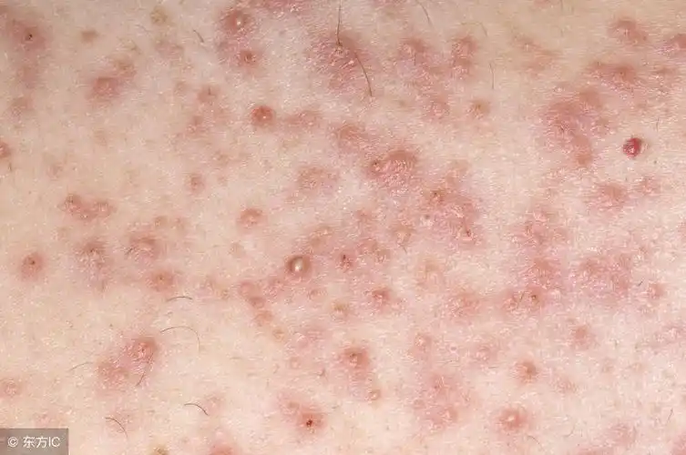 如何正确辨别毛囊炎的病症特征,有什么预防注意事项