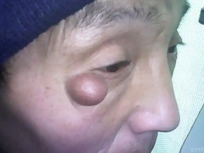 眼睑包块手术该怎么做