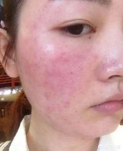 头条问答 - 脸上经常泛红,刺痒,反复冒痘痘,是过敏还是皮肤屏障受损?